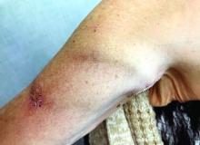 Upper arm loop grafts