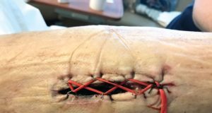 Tips and Tricks: Using a ‘Roman sandal’ after compartment syndrome treatment