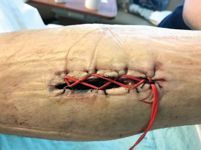 Tips and Tricks: Using a ‘Roman sandal’ after compartment syndrome treatment