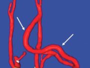 Carotid-axillary bypass for revascularization of the left subclavian artery in zone-2 TEVAR