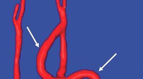 Carotid-axillary bypass for revascularization of the left subclavian artery in zone-2 TEVAR