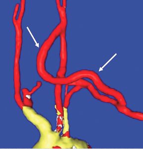 Carotid-axillary bypass for revascularization of the left subclavian artery in zone-2 TEVAR