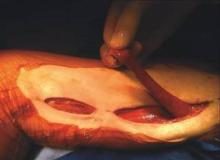 Using the gracilis muscle flap