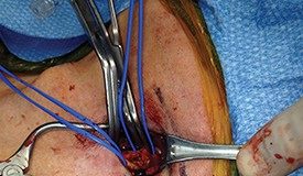 How to maximize a minimal incision