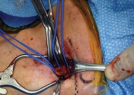 How to maximize a minimal incision