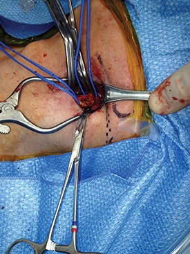 How to maximize a minimal incision