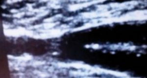 Percutaneous closure