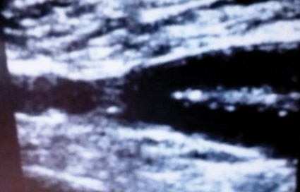 Percutaneous closure