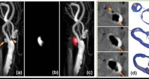 Progress Report on SVS Foundation Multicenter Clinical Studies Planning Grant