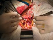 Open AAA repair volume appears to be more impactful on outcomes than years of experience, investigators reveal decline in open surgery aaa