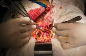 Open AAA repair volume appears to be more impactful on outcomes than years of experience, investigators reveal decline in open surgery aaa