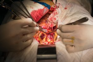 decline in open surgery aaa