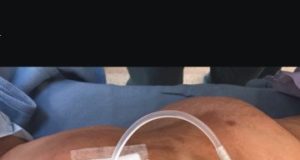 Tips and Tricks: Dealing with a troublesome peritoneal dialysis catheter