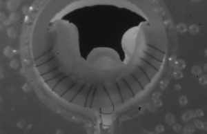 One-year data from VenoValve US pivotal trial emerges