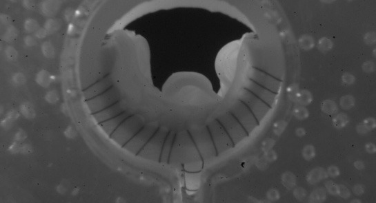 One-year data from VenoValve US pivotal trial emerges