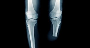 Deploying robust, detailed SVS VQI data to help better define role of paclitaxel technology in clinical practice x-ray image below knee amputation or BKA amputation