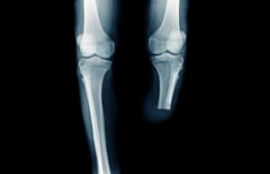 Deploying robust, detailed SVS VQI data to help better define role of paclitaxel technology in clinical practice x-ray image below knee amputation or BKA amputation