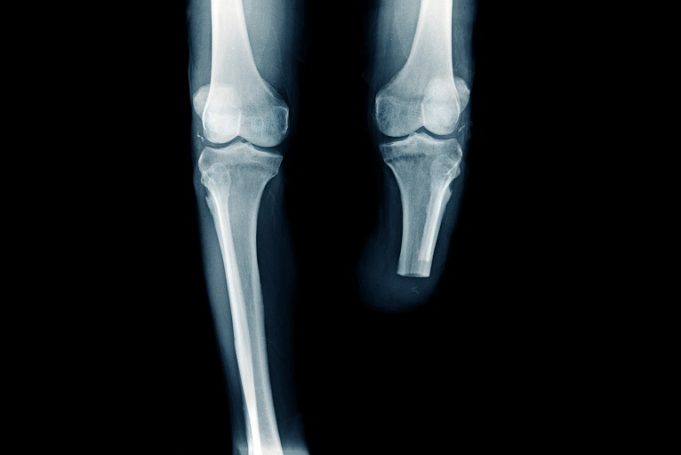 Deploying robust, detailed SVS VQI data to help better define role of paclitaxel technology in clinical practice x-ray image below knee amputation or BKA amputation