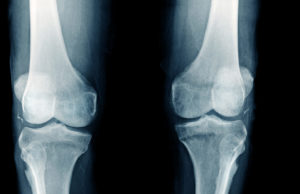 New society focused on limb preservation unveiled