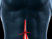 Registry data show EVAR is safe, durable and effective out to five years