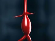 Study of patients undergoing AAA repair suggests screening guidelines may be inadequate