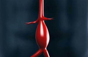 Terumo Aortic gains FDA approval for Treo endovascular device