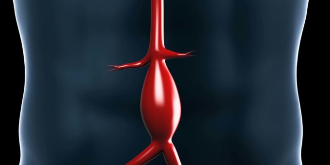 Study of patients undergoing AAA repair suggests screening guidelines may be inadequate