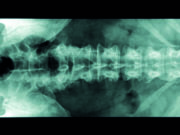 Study: Lumbar spine stabilization surgery may be a risk factor in symptomatic venous outflow obstruction lesions