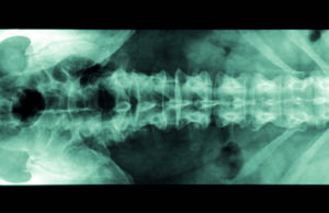 Study: Lumbar spine stabilization surgery may be a risk factor in symptomatic venous outflow obstruction lesions