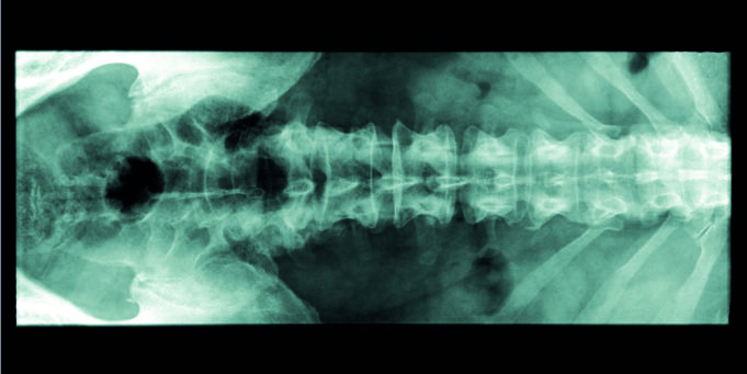 Study: Lumbar spine stabilization surgery may be a risk factor in symptomatic venous outflow obstruction lesions