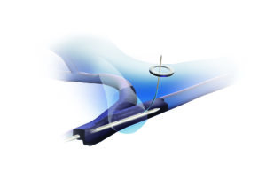 Newly FDA-approved device for central venous occlusions hailed as exciting advance