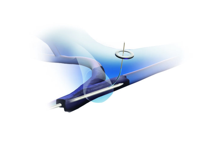 SAVE registry finds Surfacer system safe and effective