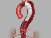 STABLE II results published on endovascular treatment of acute complicated TBAD with Cook Zenith