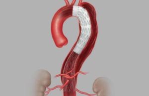 STABLE II results published on endovascular treatment of acute complicated TBAD with Cook Zenith