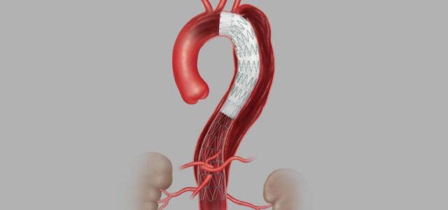 STABLE II results published on endovascular treatment of acute complicated TBAD with Cook Zenith
