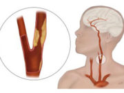 TCAR outperforms transfemoral carotid artery stenting, ‘significantly’ lowering stroke and death risk