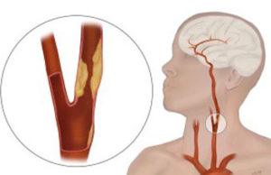 TCAR outperforms transfemoral carotid artery stenting, ‘significantly’ lowering stroke and death risk