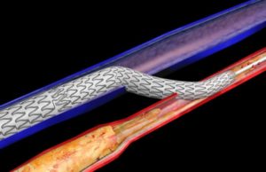 PROMISE II U.S. pivotal trial of device designed for ‘no-option’ CLTI patients completes enrollment