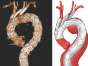 Endovascular aortic arch repair with three-vessel inner branches is safe, investigators find