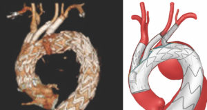Endovascular aortic arch repair with three-vessel inner branches is safe, investigators find
