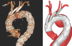 Endovascular aortic arch repair with three-vessel inner branches is safe, investigators find