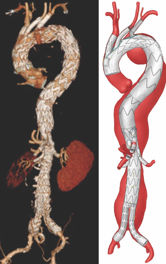 Endovascular aortic arch repair with three-vessel inner branches is safe, investigators find
