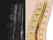 To drain or not to drain? That is the question