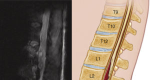 To drain or not to drain? That is the question