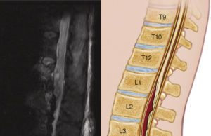 To drain or not to drain? That is the question