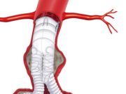 French study: Third-gen Anaconda endograft indicates satisfactory five-year exclusion