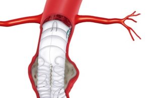 French study: Third-gen Anaconda endograft indicates satisfactory five-year exclusion