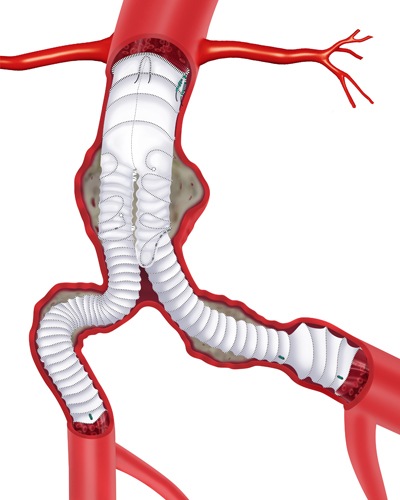 French study: Third-gen Anaconda endograft indicates satisfactory five-year exclusion