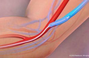 Six-month IN.PACT AV Access results show superiority of DCB angioplasty