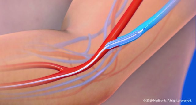 Six-month IN.PACT AV Access results show superiority of DCB angioplasty